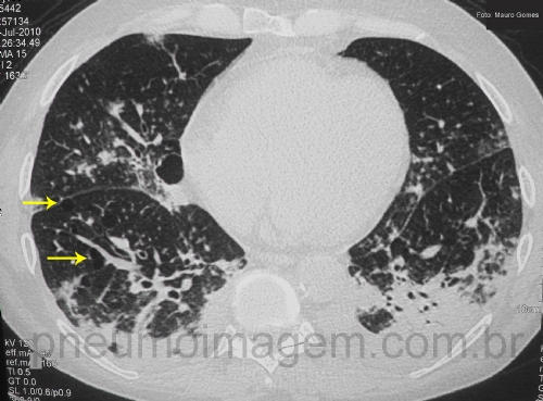 FATORES ASSOCIADOS A PATÓGENOS POTENCIALMENTE RESISTENTES A ANTIBIÓTICOS EM PNEUMONIA ADQUIRIDA NA COMUNIDADE FATORES ASSOCIADOS A PATÓGENOS POTENCIALMENTE RESISTENTES A ANTIBIÓTICOS EM PNEUMONIA ADQUIRIDA NA COMUNIDADE